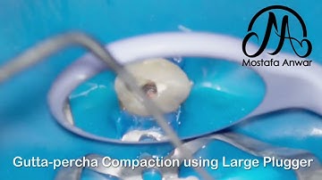 Single Cone Technique with BioCeramic Sealer | 3D Obturation | Hydraulic Condensation | Simple Easy