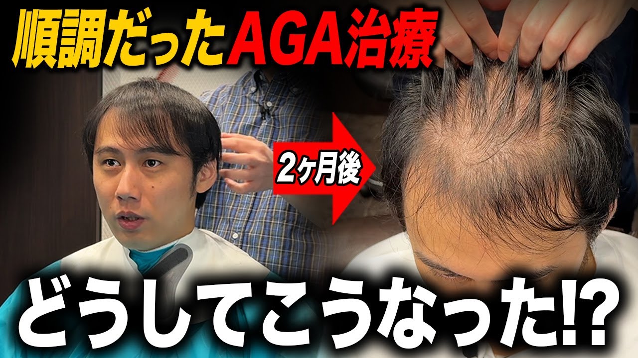 【AGA治療1年8ヶ月】まさかの薄毛リバウンド...順調だったのになぜ？