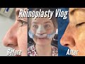 NOSE JOB VLOG - Rhinoplasty Surgery to Recovery + 3 Month Update