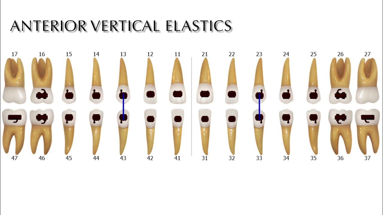 Anterior vertical elastics YouTube