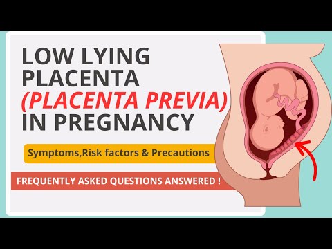 Low Lying Placenta (Placenta Previa) Explained: What Every Pregnant Woman MUST Know