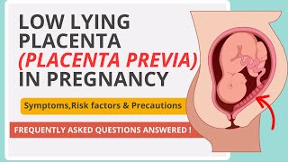 Low Lying Placenta (Placenta Previa) Explained: What Every Pregnant Woman MUST Know