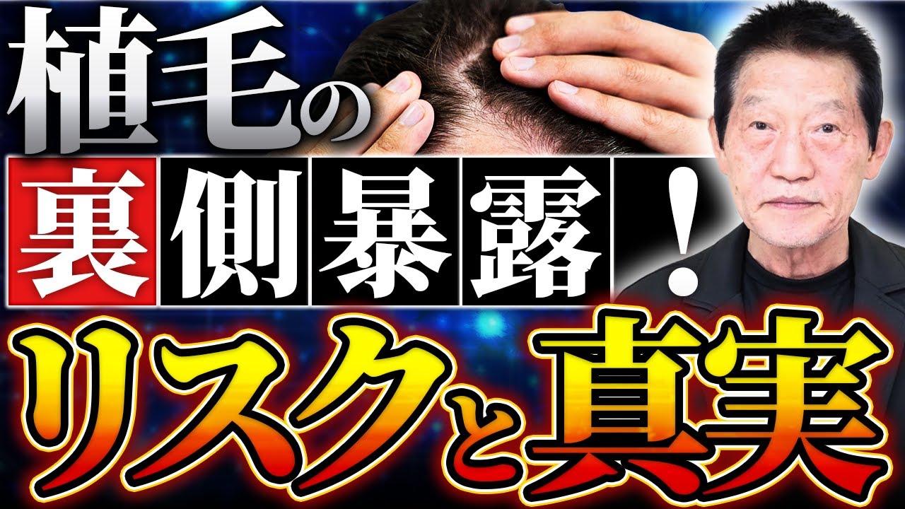 植毛についてどこよりも詳細に説明します！/リーブ21社長の発毛塾vol