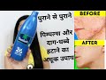 WINTER SPECIAL PIMPLE REMOVAL -  Remove Pimples, Acne, Pimple Marks completely | ThatGlamGirl