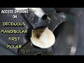 access opening on primary mandibular first molar | demo step by step