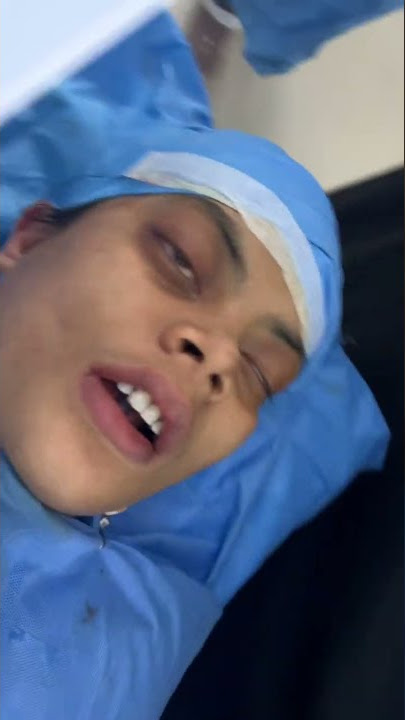 Bimax surgery for facial proportion correction