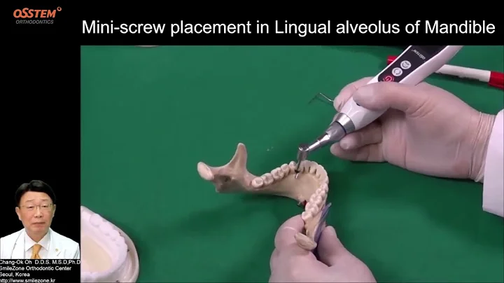 11. Lingual side of Mandibular (When and How to use "Orthodontic Screw")