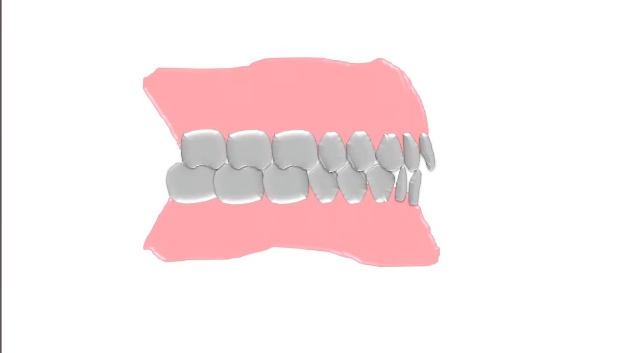 Phonetics in Complete Denture | Prosthodontics