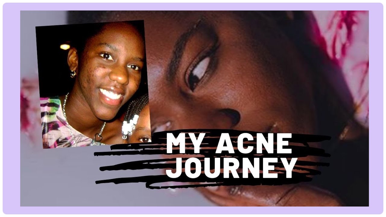 HOW I CLEARED MY SKIN IN A MONTH | Acne Journey + Products Used - YouTube