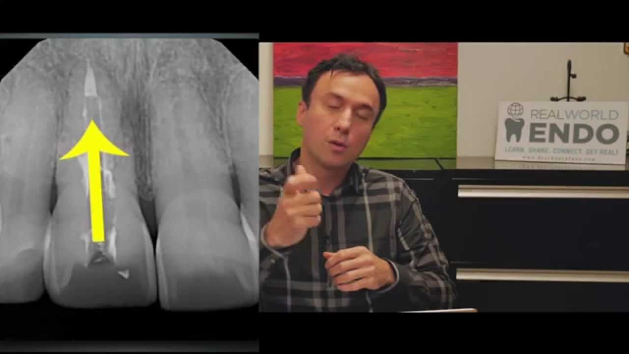 CBL #11: External Root Resorption Repair