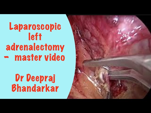 Laparoscopic left adrenalectomy - master video
