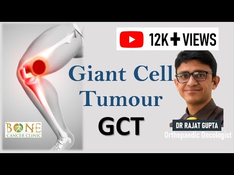 GIANT CELL TUMOUR I GCT (Bone Tumour) Hindi Subtitles - Causes I Symptoms I Treatment I Surgery