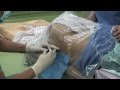今週の硬膜外麻酔4例 epidural anesthesia by Dr.EpiCal
