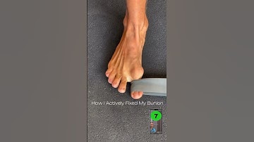 He Finally Fixed His BUNIONS!🤯