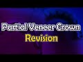 crown|partial veneer crown revision