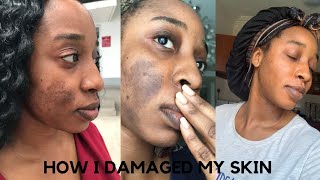 HOW I DAMAGED MY SKIN| LEARN FROM MY MISTAKES | SKINCARE |