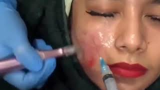 Video M-Coll Indonesia Bebas Jerawat Tanpa Kulit Kusam