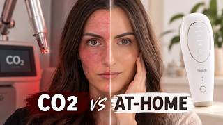 $600 At-Home Laser vs. $2,000 CO₂ Laser: Is It Even Comparable? | MimiSilk Iris Review