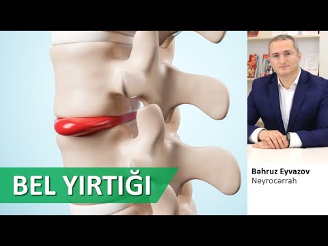 Video: Yırtığı necə müalicə etmək olar: diaqnoz, evdə qulluq və cərrahiyyə seçimləri