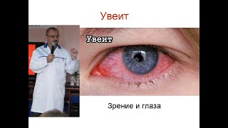 Увеит – аутоиммунное воспаление глаза. И его лечение.