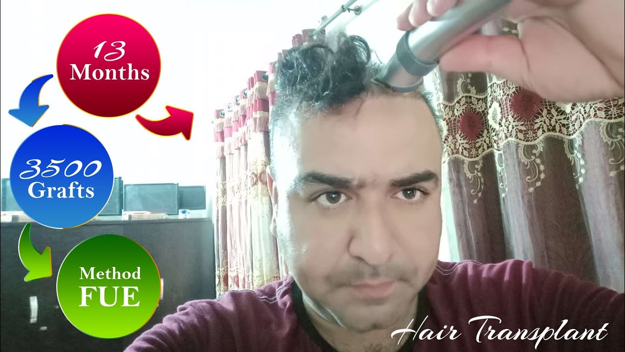 Head Shave After Hair Transplant 13 Months Hair Transplant FUE 3500 Grafts YouTube