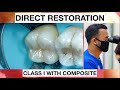 Step by Step Layering Composite I Simple Way | General Dentist Griya RR