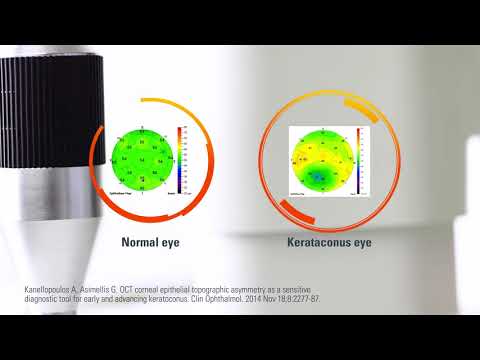 Epithelial Thickness Mapping by Optovue