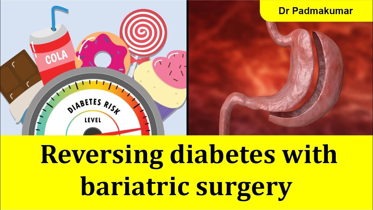 Is diabetic reversal possible? | Reversing diabetes with bariatric ...