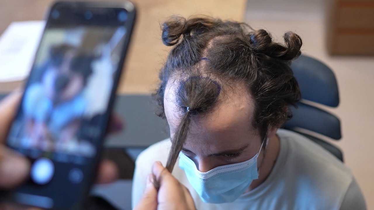 Trapianto di capelli: una storia emozionante!