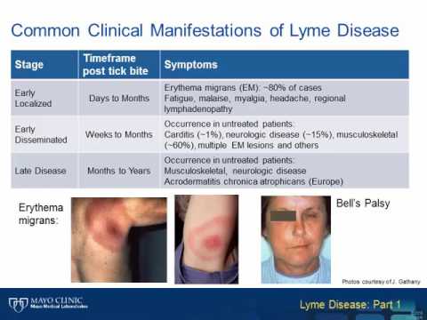 Video: HUMTICK-undersøgelsen: Protokol Til En Prospektiv Kohortundersøgelse Af Lyme-sygdomssyndrom Efter Behandling Og Sygdommen Og Omkostningsbyrden Ved Lyme Borreliosis I Belgien