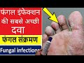 फंगल इंफेक्शन की सबसे अच्छी दवा|| Best treatment of fungal infection |