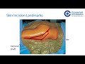 Surgical Approach - Kocher Langenbach Approach @Conceptual Orthopedics
