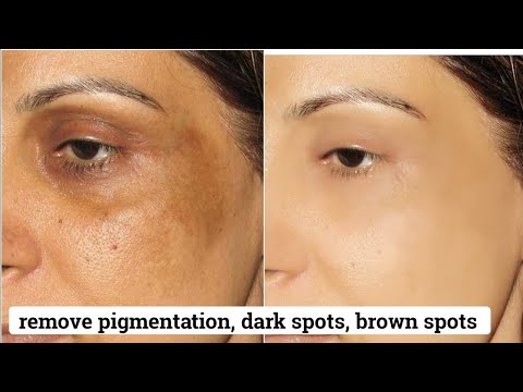 skin pigmentation brown patches