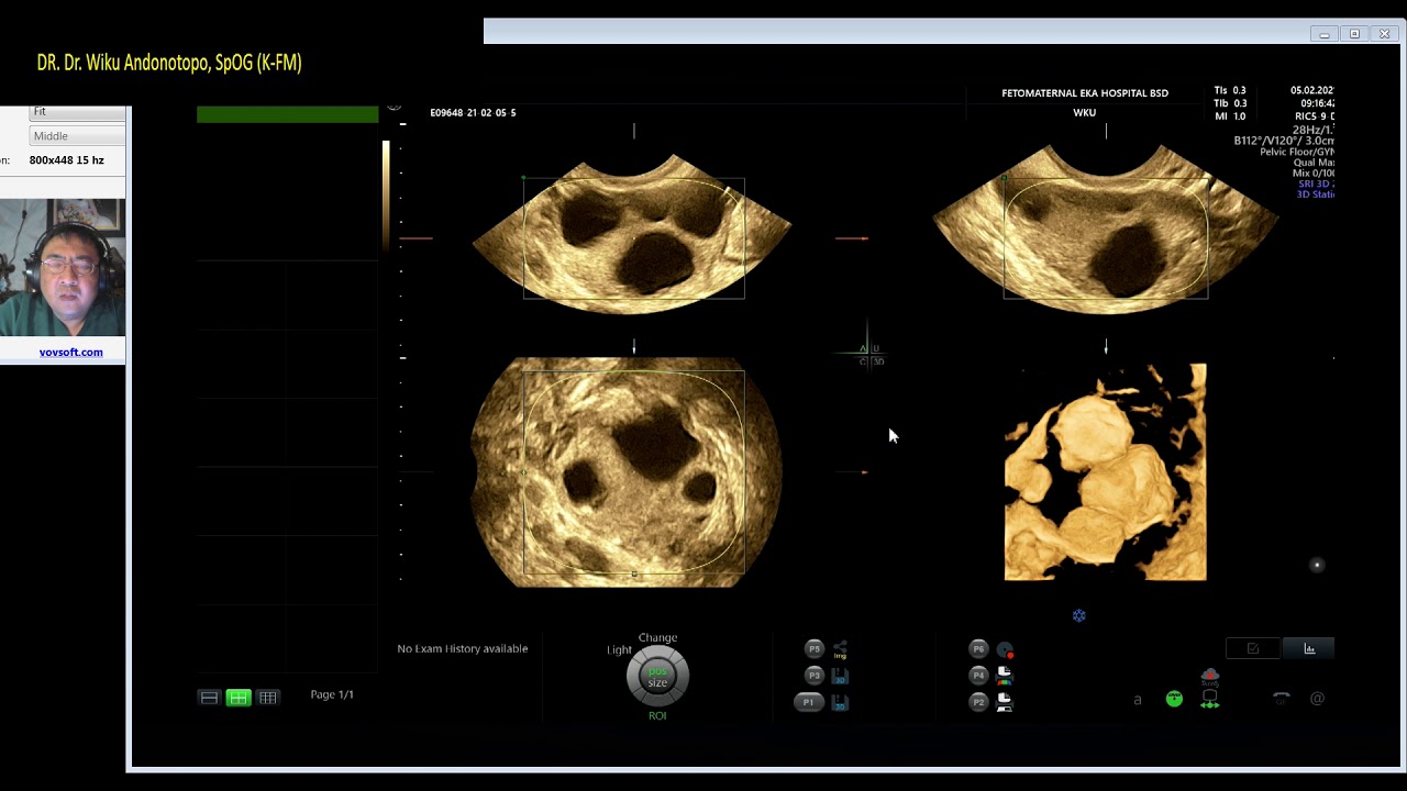 STIMULASI INDUKSI OVULASI (Dr Wiku Andonotopo)