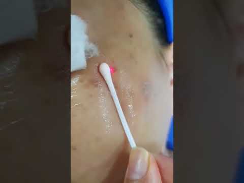 thẩm mỹ viện ngọc hương 2022 Update Cận cảnh quy trình điều trị đốm nâu bằng Laser