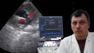 Детская Эхокардиография (УЗИ сердца) - Стеноз легочной артерии у ребенка