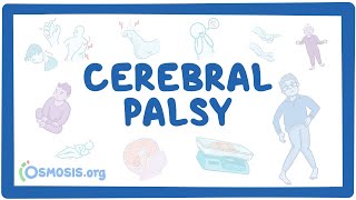 Cerebral palsy (CP) - causes, symptoms, diagnosis, treatment, pathology