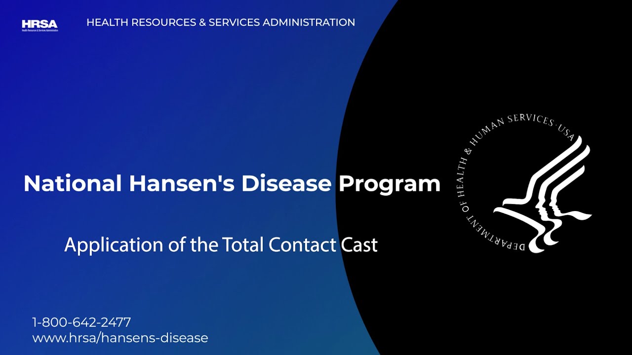 Application of a Total Contact Cast