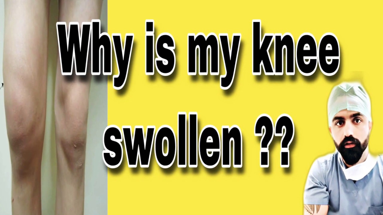 Why Is My Knee Swollen Knee Swelling Causes And Treatment Youtube