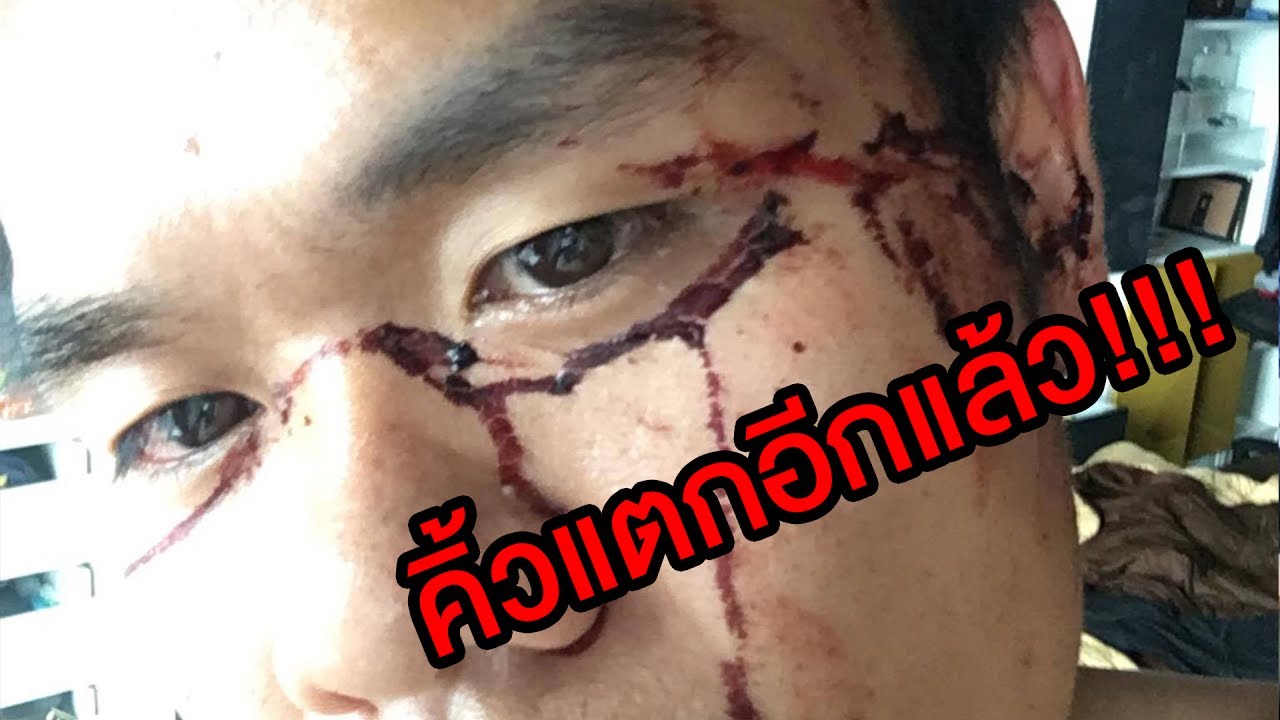 นักรบย่อมมีบาดแผล!!! คิ้วแตกอีกแล้ว - บี้ เดอะสกา