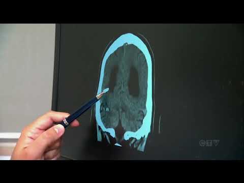 Video: Ar kam nors buvo klaidingai diagnozuota Parkinsono liga?