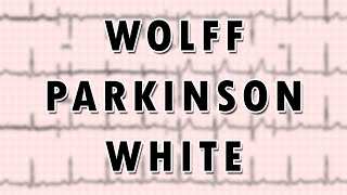 Wolff-Parkinson-White Syndrome