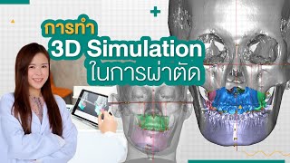 การทำ 3D Simulation ในการผ่าตัดขากรรไกรร่วมกับการจัดฟัน