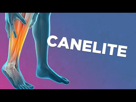 Vídeo: 3 maneiras de saber se você torceu o joelho