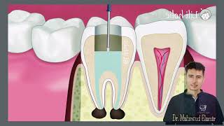 فيديو طريقة حشو عصب الاسنان وعلاج جذور الاسنان endo 2