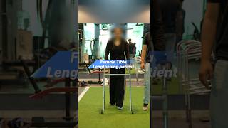 Female Tibia Lengthening patient | Height increase surgery in India