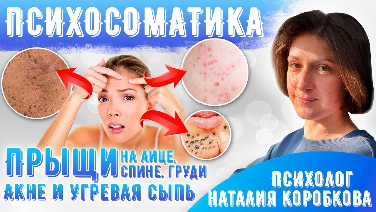 Прыщи на лице /Акне/ Угревая сыпь/ Психосоматика.