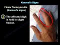 Kanavel&#39;s Signs, infection of the flexor tendons