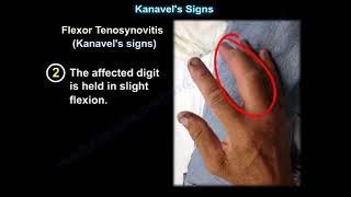 Kanavel's Signs, infection of the flexor tendons
