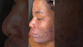 Chemical peel safe for skin of color